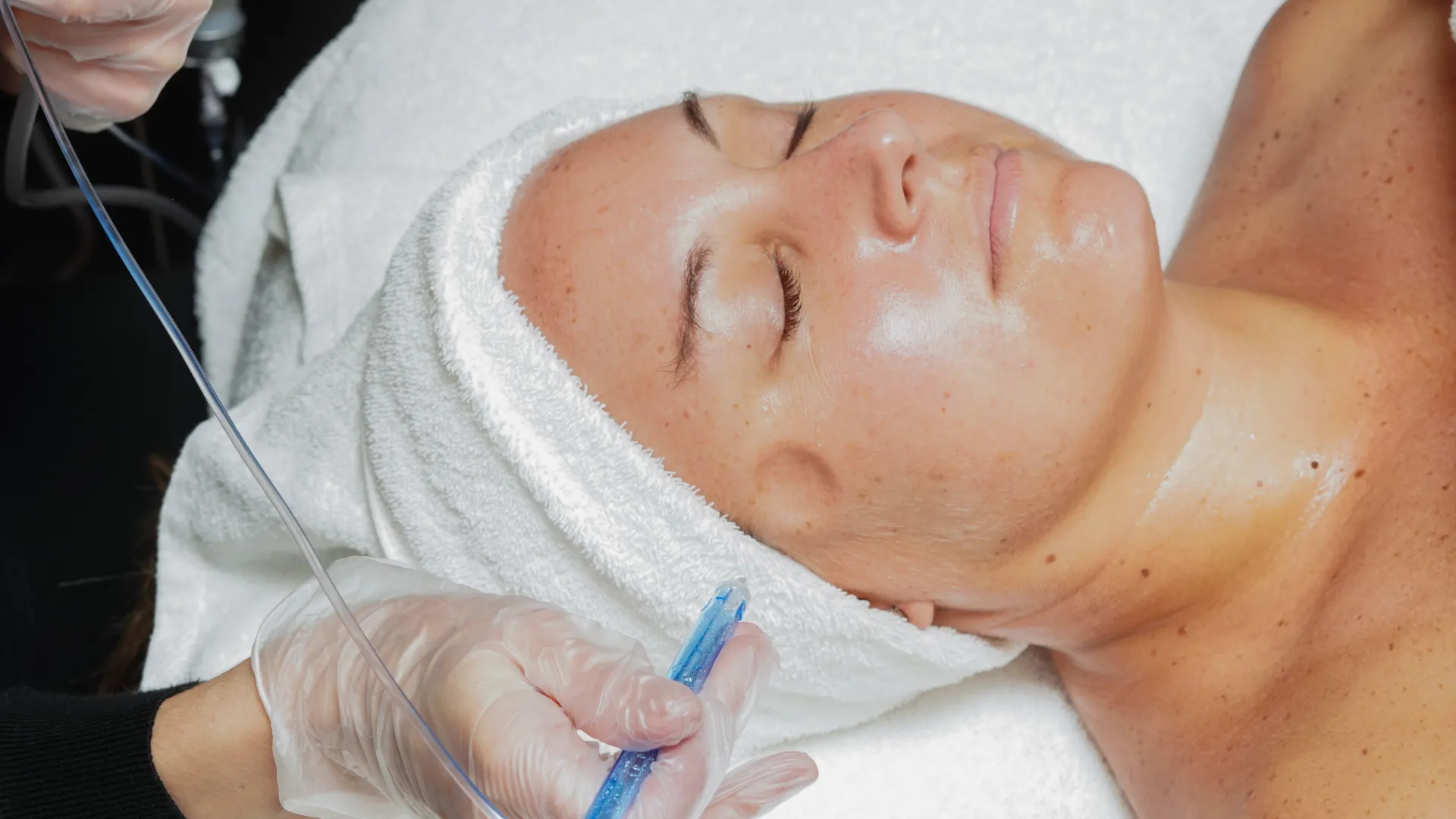 Woman receiving jetpeel facial